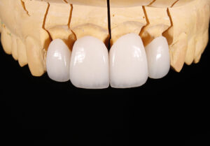 Coroa em emax (dissilicato de lítio)