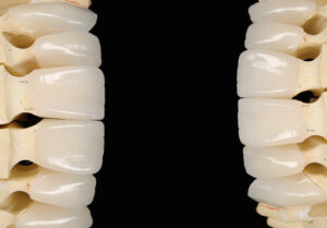 Coroas em emax (dissilicato de lítio)