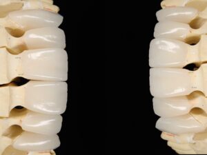 Coroas em emax (dissilicato de lítio)