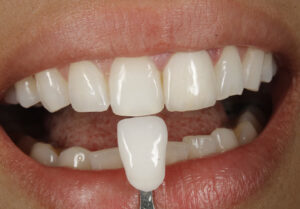 Personalização de casos com tomada de cor