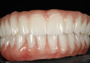 Protocolo cerâmico superior e protocolo resina inferior